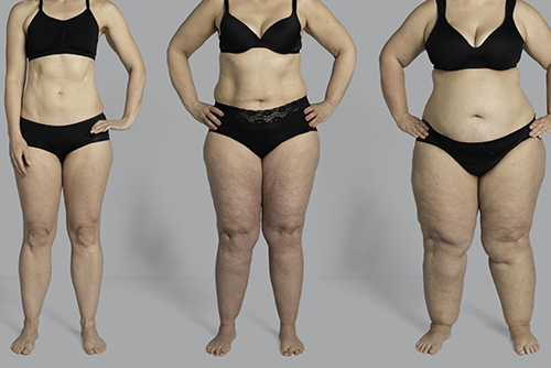 Women with lipedema have major health problems but wait decades for correct  diagnosis - Research - Jönköping University