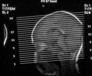 Bild från en hjärnröntgen av ett barns hjärna